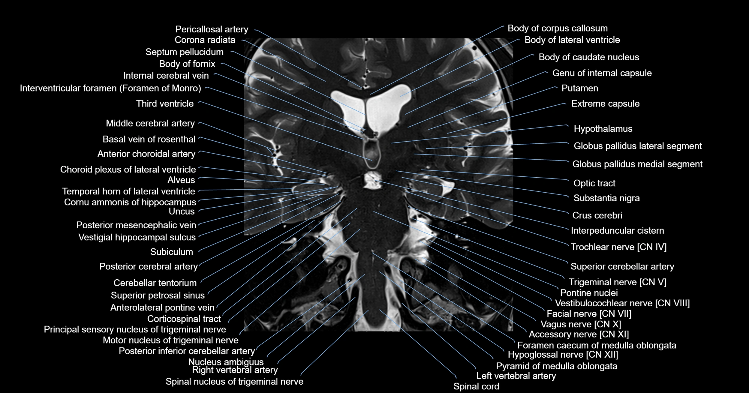 MRI brainstem & basal ganglia anatomy labelled 3T MRI images -img-00001-00020.webp